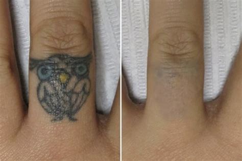 Laser Tattoo Removal Before & After Photos Vanish Laser