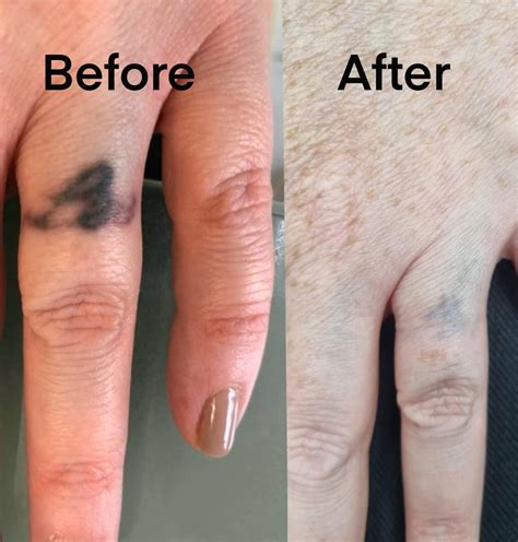 Laser Tattoo Removal Shrewsbury, NJ Sycamore Medi Spa