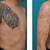 Tattoo Removal Skin Graft