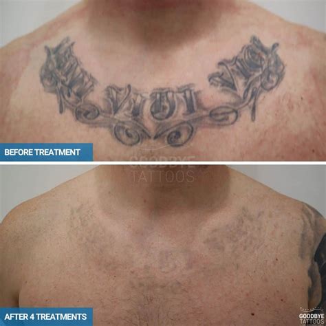 Laser Tattoo Removal Results Tattoo Removal Sydney by