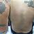 Tattoo Removal Townsville