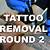 Tattoo Removal Tucson Az