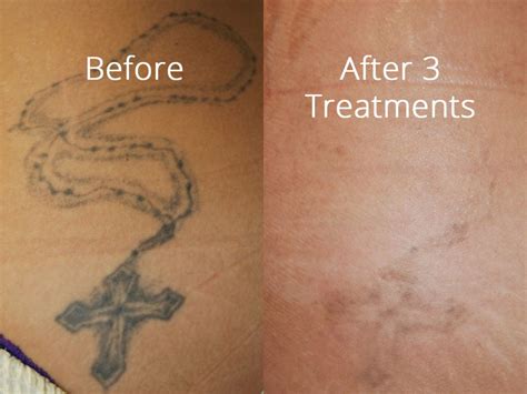 Tattoo Removal in West Vancouver Dr. Shadan Kabiri