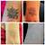 Tattoo Removal Worthing