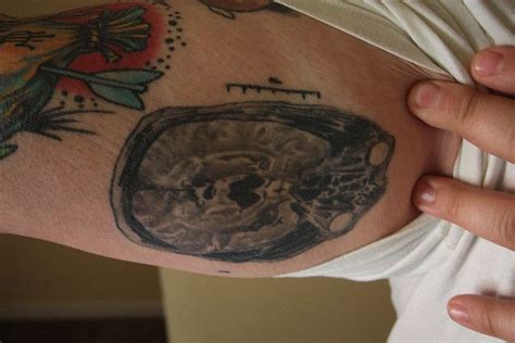 Do Tattoos and MRI Scans Interact?