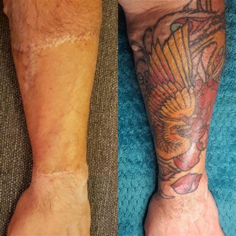 Inked Beauty: Transforming Skin Graft with a Stunning Tattoo Design