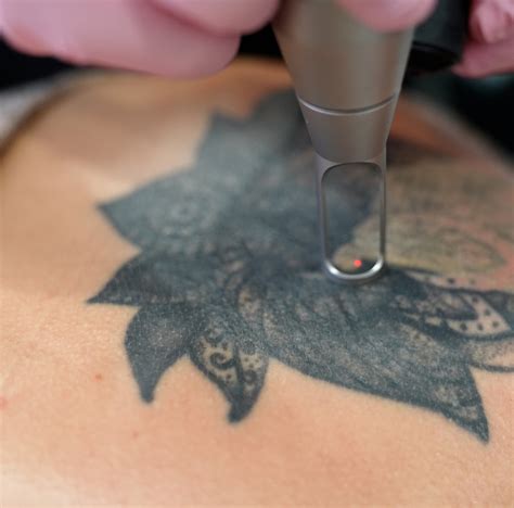 Tattoo Removal Austin
