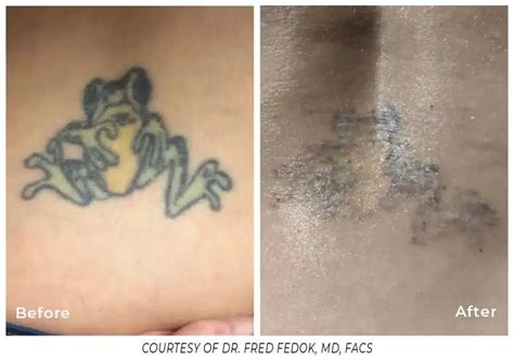 Tattoo Removal Baton Rouge Tatto Pictures