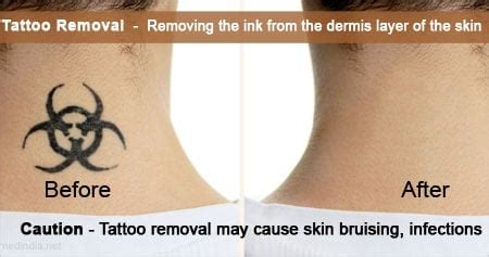 Tattoo Removal Birmingham Solihull Medical Cosmetic Clinic