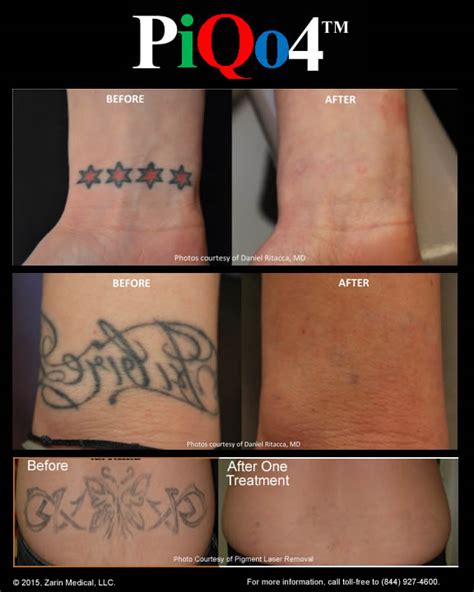 Southern California Laser Tattoo RemovalBefore and After