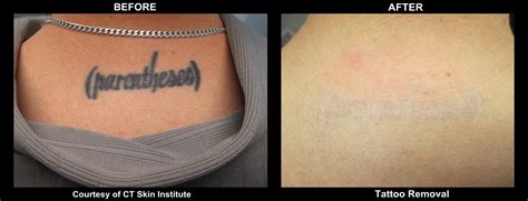 laser, tattoo removal, pico, picosure, enlighten, cutera