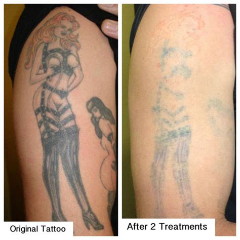Tattoo Removal Corpus Christi Tx Unique Kaykay Turney