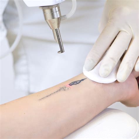 Tattoo Laser Tattoo Removal (Per Course) Tatu Society