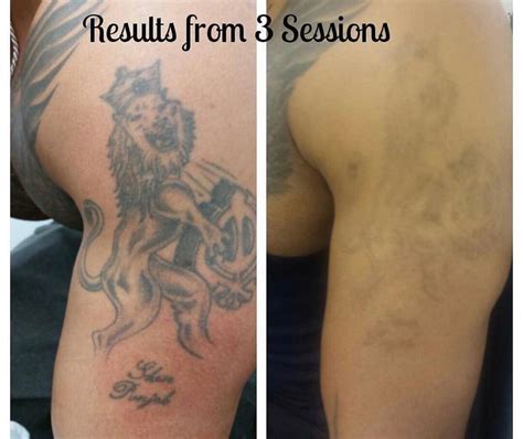 go ink tattoo removal coventry Highest Price Biog Stills