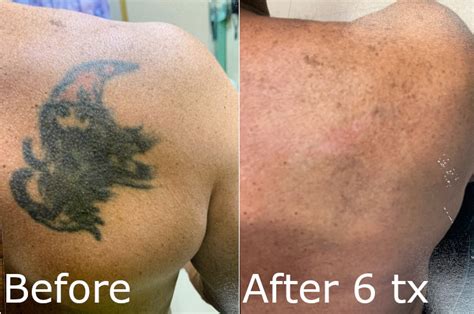 Laser Tattoo Removal Before and After Connecticut Skin