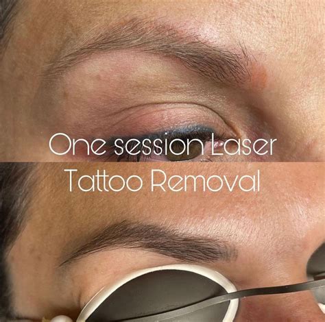 Tattoo Removal Dallas Tx