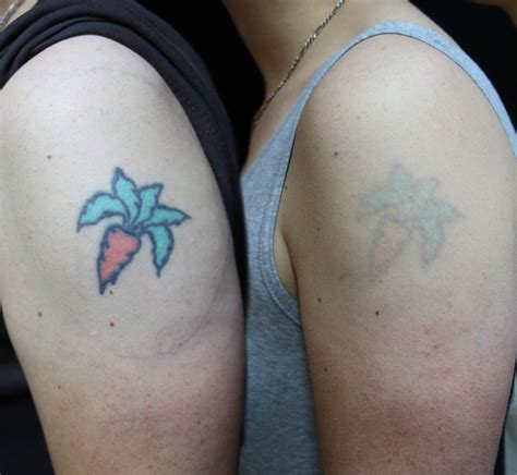 Efficient Tattoo Removal Services in Grand Rapids - Get Ink-Free!