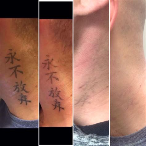 Tattoo Removal Service «Tattoo Bills», reviews and photos