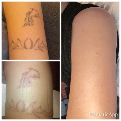10 Off at Atlantic Tattoo Removal LOCALS ONLY VIRGINIA