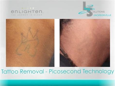 Laser Tattoo Removal Southside Dermatology & Laser