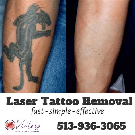 Tattoo Removal Specialist Lexington, KY Jazzi Cosmetic