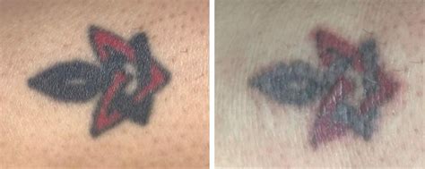 Laser Tattoo Removal Ink Illusions