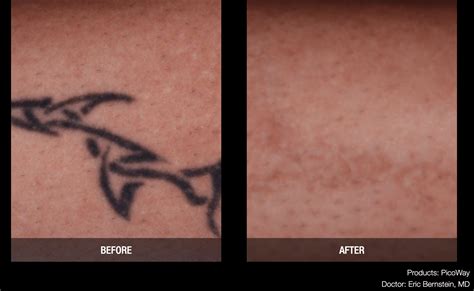Tattoo Removal Memphis Laser Clinic and Medspa