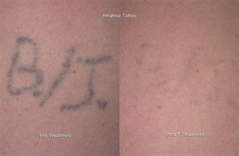2 Day Laser Tattoo Removal Training Course Minnesota