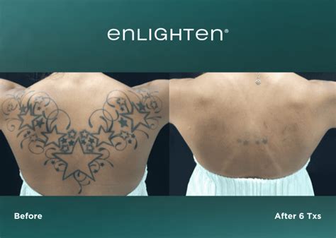 Tattoo Removal Omaha