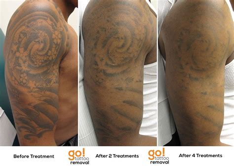 Tattoo Removal Before & After Photos from Astanza