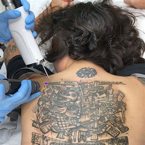 Tattoo Removal Orange County Ca The Power Of Picosure