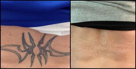 Tattoo Removal Philadelphia