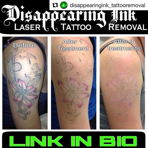 Pittsburgh's Leader in Laser Tattoo Removal Elimination