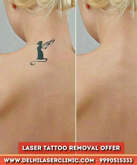 Laser Tattoo Removal Services Excellase Raleigh