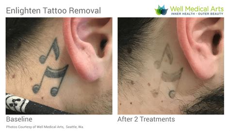 Tattoo Removal Seattle