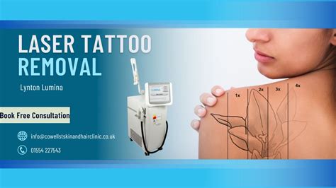 Tattoo Removal Service Near Me