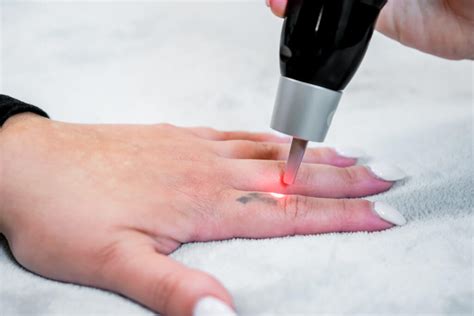 The Laser Tattoo Removal Business Everything you need to