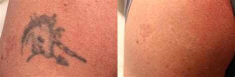 Laser Tattoo Removal In Spokane The Brow Room