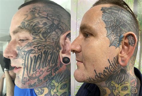 Tattoo Removal Wellington / Body Details True Laser