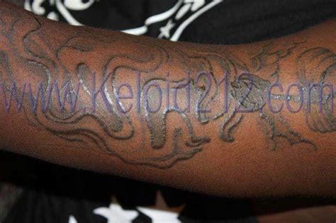 Tattoo With Keloid