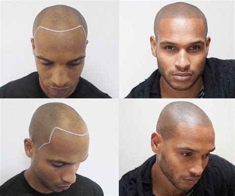 Guys Are Tattooing Hair onto Their Bald Heads Head