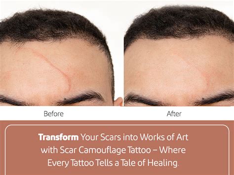 Transforming Scars into Art: The Beauty of Skin Color Tattooing