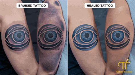 Tattoos And Bruising