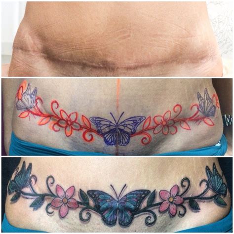 Tattoos For Covering Tummy Tuck Scars