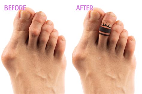 Tattoos On Toes To Cover Corns