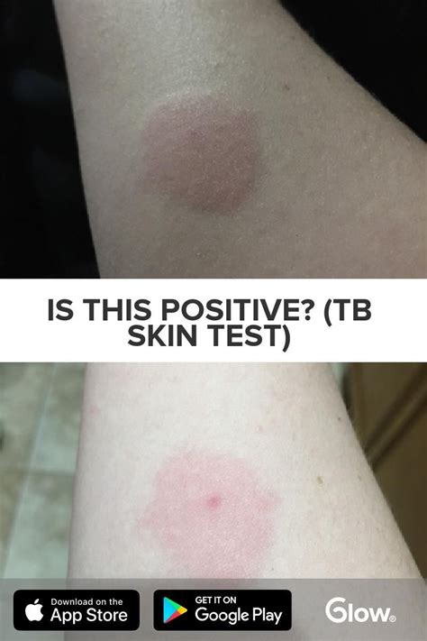 Unveiling the Mystery of TB Skin Test Bruise: Understanding its Causes and Prevention Strategies