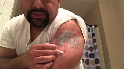 TCA 50 Tattoo Removal 1st Application Part 2 of 2
