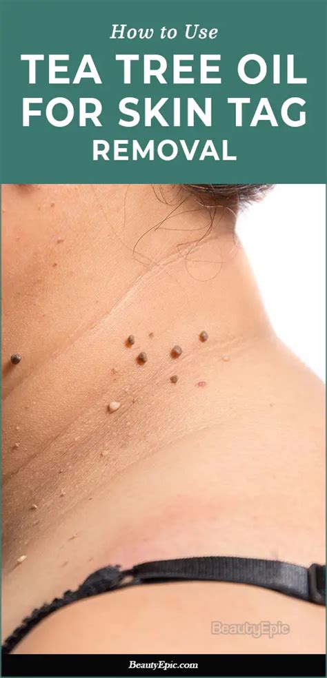 Say Goodbye to Skin Tags Forever with the Magic of Tea Tree Oil