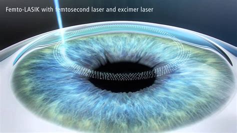 Technology Matters: Femtosecond vs. Standard LASIK