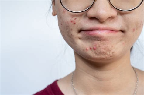 Teenage Acne May Be a Natural, Transient Inflammatory State